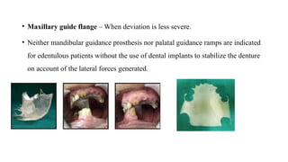 Maxillary Ramps ACQUIRED MANDIBULAR DEFECTS.pptx defects m | PPTX