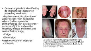 Extensor Rash Acquired Myopathies: A Comprehensive Clinical Approach to Inflammatory ...