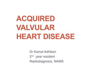 ACQUIRED
VALVULAR
HEART DISEASE
Dr Kamal Adhikari
2nd year resident
Radiodiagnosis, NAMS
 