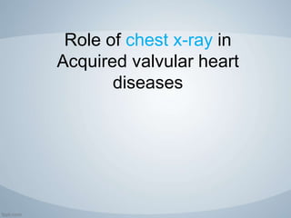 Role of chest x-ray in
Acquired valvular heart
diseases
 