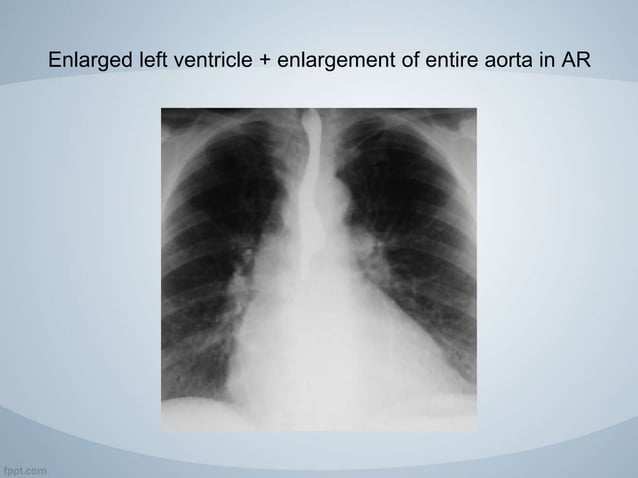 Acquired valvular heart diseases with x ray findings | PPTX