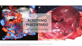 ACRETISMO
PLACENTARIO
Calì, G., Foti, F. & Minneci, G. (2017). 3D power Doppler in the evaluation of abnormally invasive placenta. Journal of Perinatal Medicine,
45(6), pp. 701-709. Retrieved 6 May. 2018, from doi:10.1515/jpm-2016-0387
Cesar David Ordoñez Domínguez
 