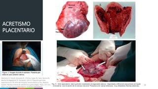 12
ACRETISMO
PLACENTARIO
Abehsera D, Daniel, González B, Cristina, López M, Sara, Sancha N,
Marta, & Magdaleno D, Fernando. (2011). Placenta percreta,
experiencia en 20 años del Hospital Universitario La Paz, Madrid,
España. Revista chilena de obstetricia y ginecología, 76(2), 127-131.
https://dx.doi.org/10.4067/S0717-75262011000200011
 