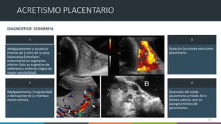 13
Adelgazamiento o ausencia
(menos de 1 mm) de la zona
hipoecoica (interface)
endometrial en segmento
inferior. Esto es sugestivo de
adherencia anómala (signo de
mayor sensibilidad)
Espacios lacunares vasculares
placentario.
Adelgazamiento, irregularidad
o disrrupcion de la interfase
vesico-uterina.
Extensión del tejido
placentario a través de la
serosa uterina, que es
patognomónico de
percretismo.
1
3
2
4
ACRETISMO PLACENTARIO
DIAGNOSTICO: ECOGRAFIA
 