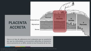 PLACENTA
ACCRETA
Este es un tipo de adherencia de la placenta que se caracteriza
por que las vellosidades se encuentran adheridas al miometrio,
esta se presenta en un 80%, siendo la mas frecuente de las tres.
Cunningham FG, Leveno KJ, Bloom SL, Spong CY, Dashe JS, Hoffman BL, et al. Obstetrical Hemorrhage. Williams Obstetrics, 24e. New
York, NY: McGraw-Hill Education; 2013.
 