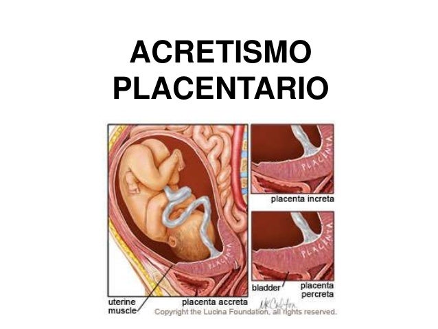 Resultado de imagen para acretismo placentario