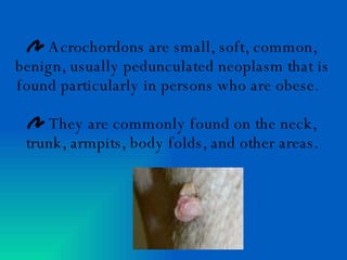 Acrochordons are small, soft, common, benign, usually pedunculated neoplasm that is found particularly in persons who are obese.  They are commonly found on the neck, trunk, armpits, body folds, and other areas. 