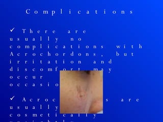 Complications There are usually no complications with Acrochordons, but irritation and discomfort may occur occasionally. Acrochordons are usually cosmetically unsightly. 