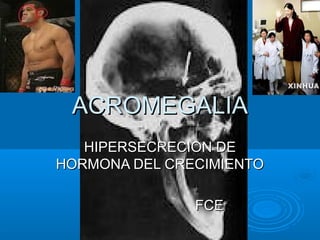 ACROMEGALIAACROMEGALIA
HIPERSECRECION DEHIPERSECRECION DE
HORMONA DEL CRECIMIENTOHORMONA DEL CRECIMIENTO
FCEFCE
 