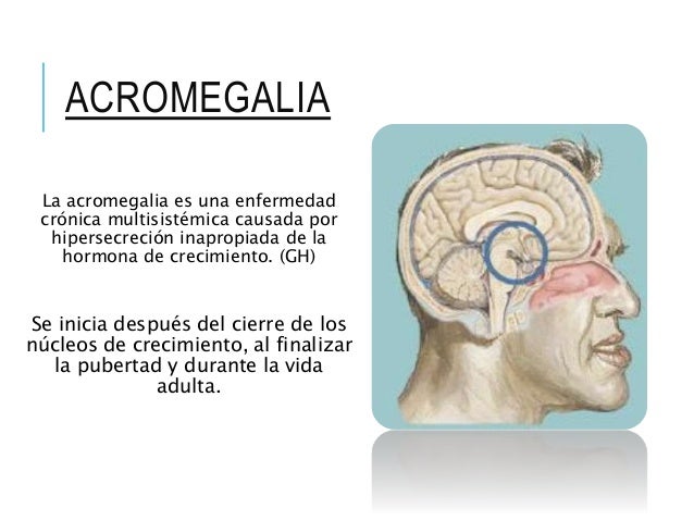 Acromegalia Acromegalia