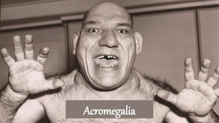 Acromegalia
 
