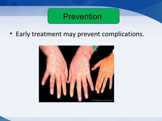 Preventions
• Early treatment may prevent complications.
Prevention
 