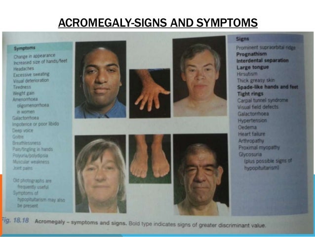 nursing bibs: acromegaly due to pituitary tumor