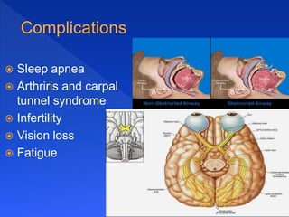  Sleep apnea
 Arthriris and carpal
tunnel syndrome
 Infertility
 Vision loss
 Fatigue
 