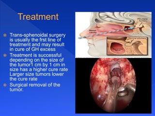  Trans-sphenoidal surgery
is usually the frst line of
treatment and may result
in cure of GH excess
 Treatment is successful
depending on the size of
the tumor1 cm by 1 cm in
size has a higher cure rate
Larger size tumors lower
the cure rate
 Surgical removal of the
tumor.
 
