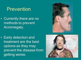  There is no way to prevent acromegaly.
 