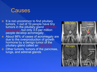  It is not uncommon to find pituitary
tumors. 1 out of 10 people have tiny
tumors in the pituitary gland (pituitary
adenoma), but only 3.5 per million
people develop acromegaly
 About 98% of cases of acromegaly are
due to the overproduction of growth
hormone by a benign tumor of the
pituitary gland called an adenoma
 Other tumors. tumors of the pancreas,
lungs, and adrenal glands
 
