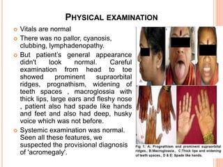 PHYSICAL EXAMINATION
 Vitals are normal
 There was no pallor, cyanosis,
clubbing, lymphadenopathy.
 But patient’s general appearance
didn't look normal. Careful
examination from head to toe
showed prominent supraorbital
ridges, prognathism, widening of
teeth spaces , macroglossia with
thick lips, large ears and fleshy nose
, patient also had spade like hands
and feet and also had deep, husky
voice which was not before.
 Systemic examination was normal.
Seen all these features, we
suspected the provisional diagnosis
of 'acromegaly'.
 
