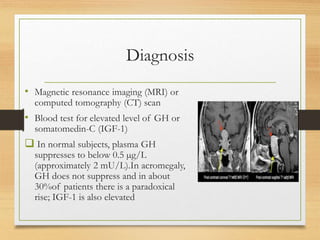 Acromegaly description causes treatment. | PPTX