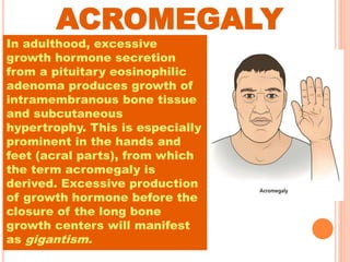 ACROMEGALY
In adulthood, excessive
growth hormone secretion
from a pituitary eosinophilic
adenoma produces growth of
intramembranous bone tissue
and subcutaneous
hypertrophy. This is especially
prominent in the hands and
feet (acral parts), from which
the term acromegaly is
derived. Excessive production
of growth hormone before the
closure of the long bone
growth centers will manifest
as gigantism.
 
