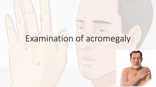 Examination of acromegaly
.
 