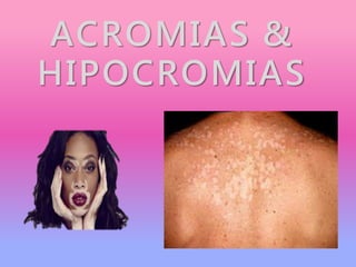 ACROMIAS &
HIPOCROMIAS
 