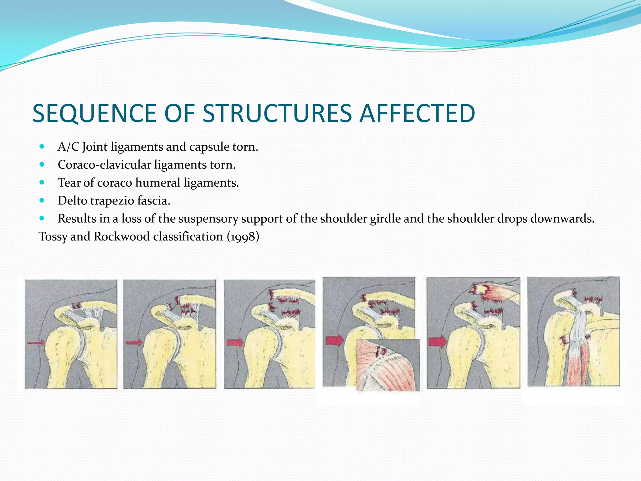 Ac Classification Rockwood Classification Of Acromioclavicular Joint Acromioclavicular