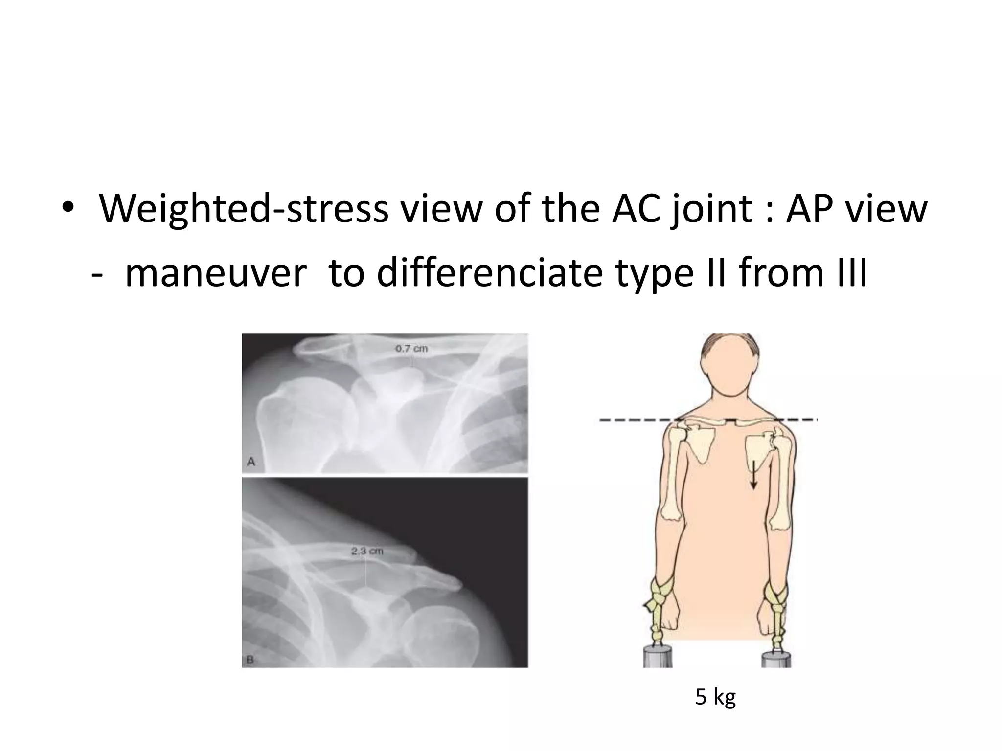 • Weighted-stress view of the AC joint : AP view
- maneuver to differenciate type II from III
5 kg
 