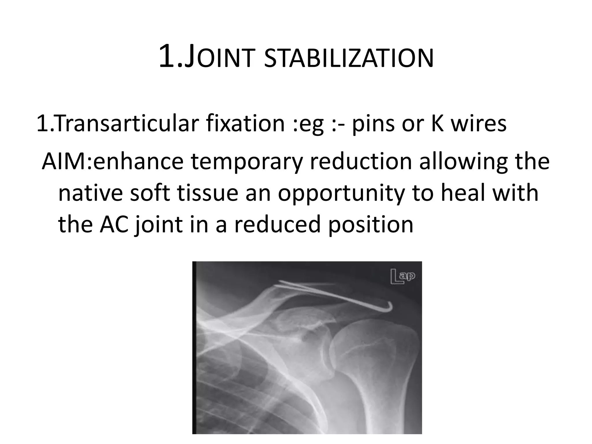 1.JOINT STABILIZATION
1.Transarticular fixation :eg :- pins or K wires
AIM:enhance temporary reduction allowing the
native soft tissue an opportunity to heal with
the AC joint in a reduced position
 