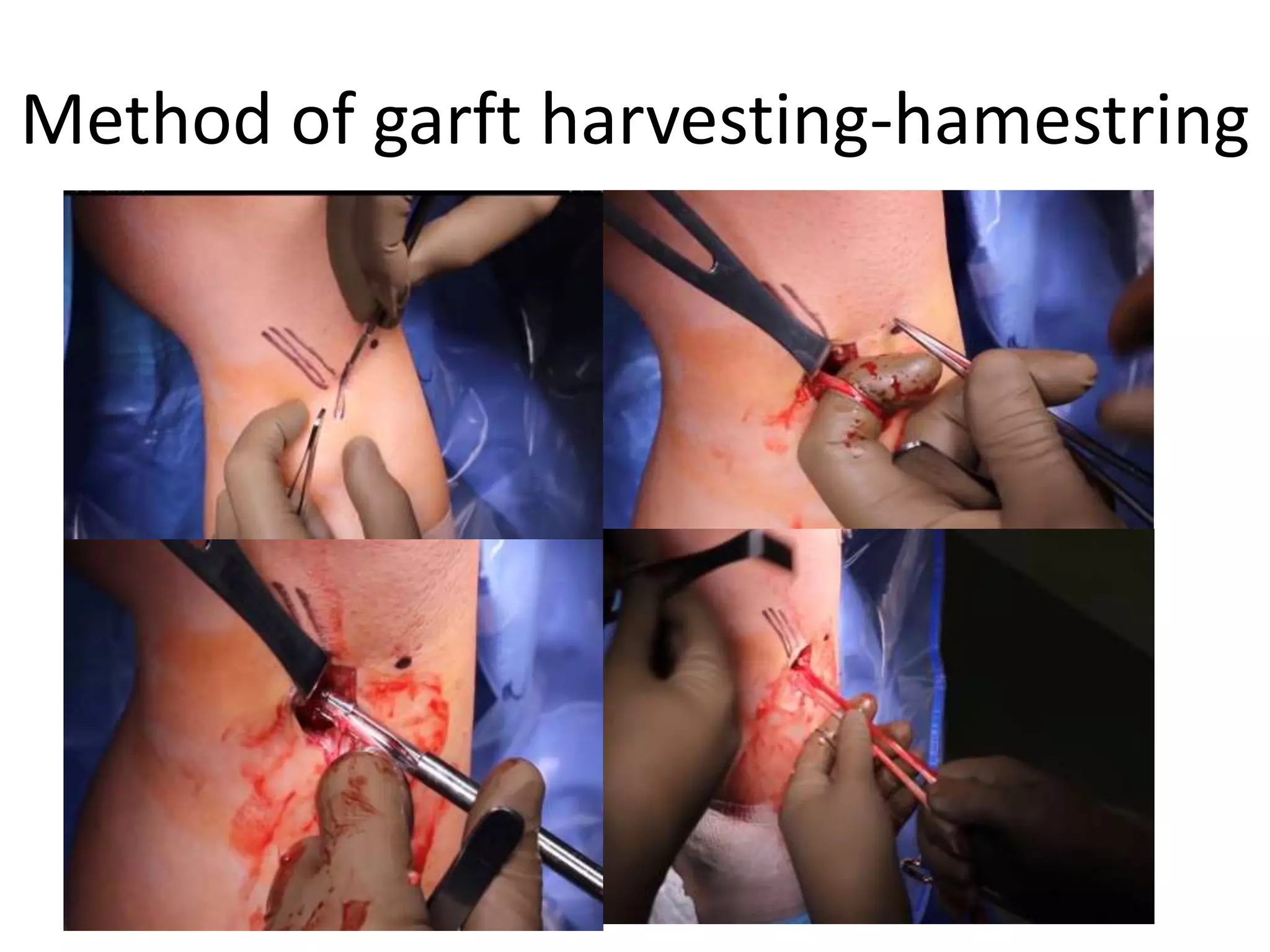 Method of garft harvesting-hamestring
 