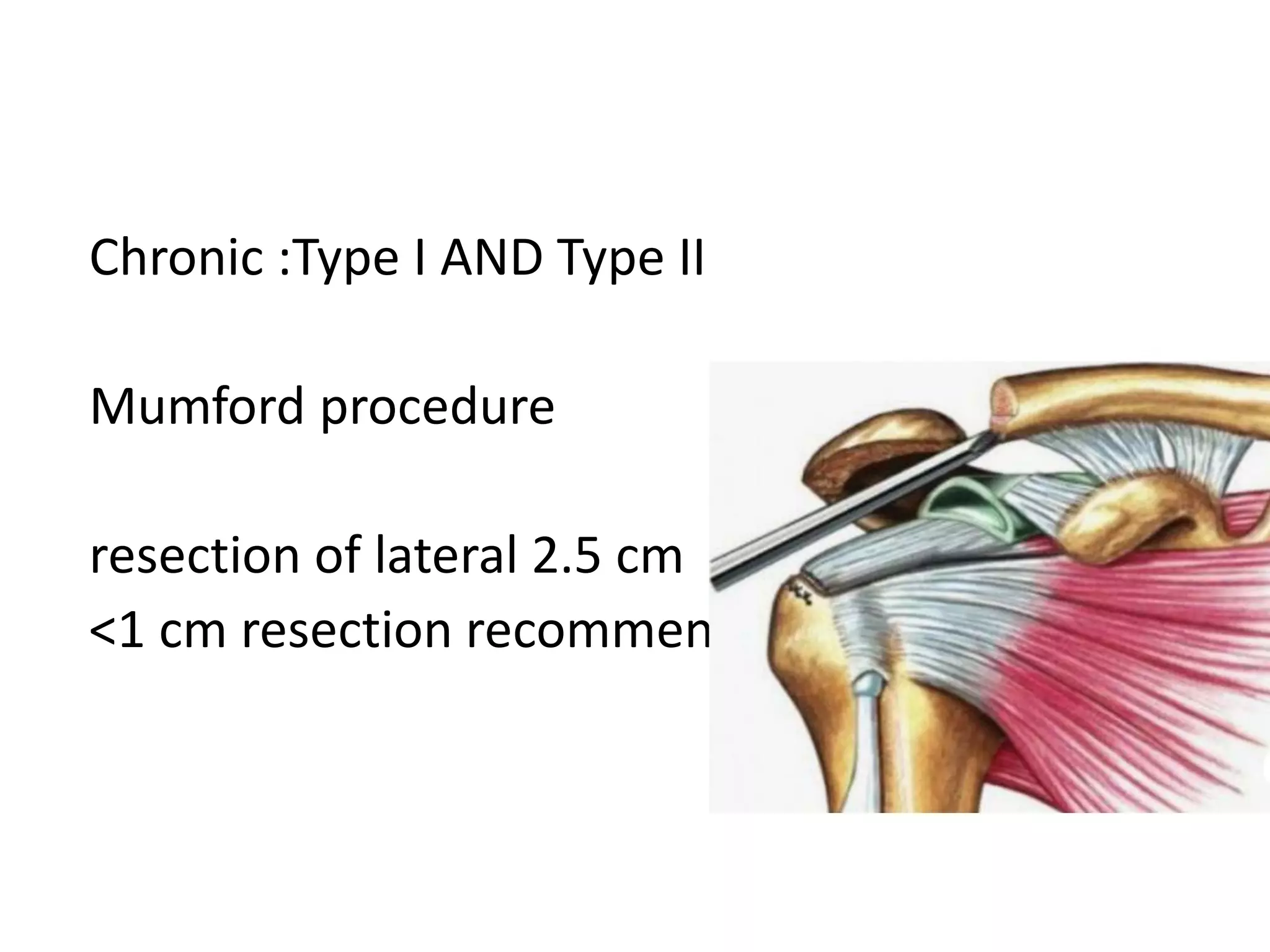 Chronic :Type I AND Type II
Mumford procedure
resection of lateral 2.5 cm
<1 cm resection recommended
 
