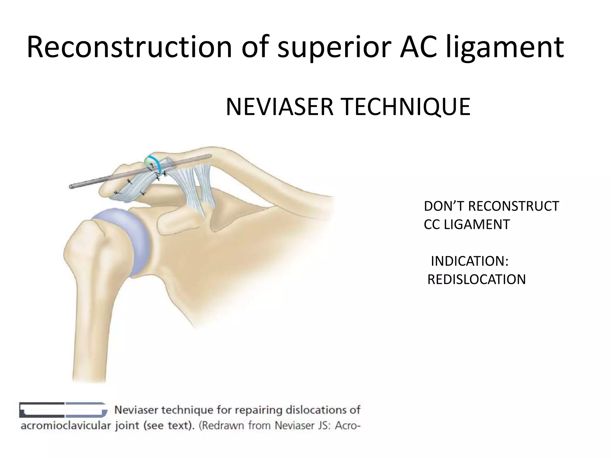 Reconstruction of superior AC ligament
DON’T RECONSTRUCT
CC LIGAMENT
INDICATION:
REDISLOCATION
NEVIASER TECHNIQUE
 
