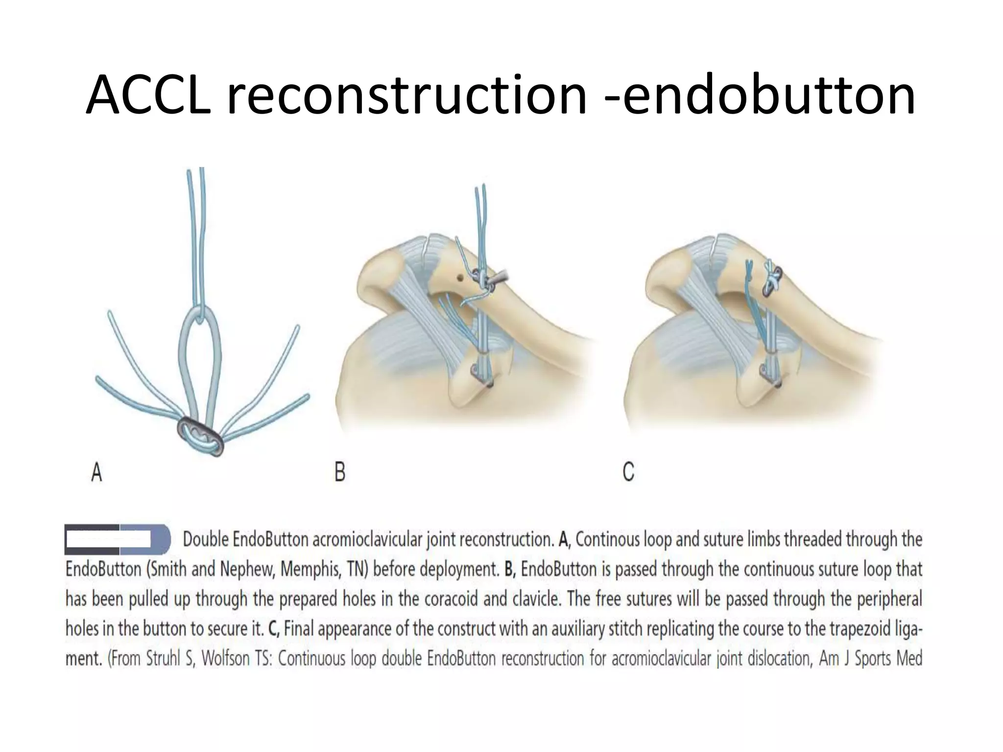 ACCL reconstruction -endobutton
 