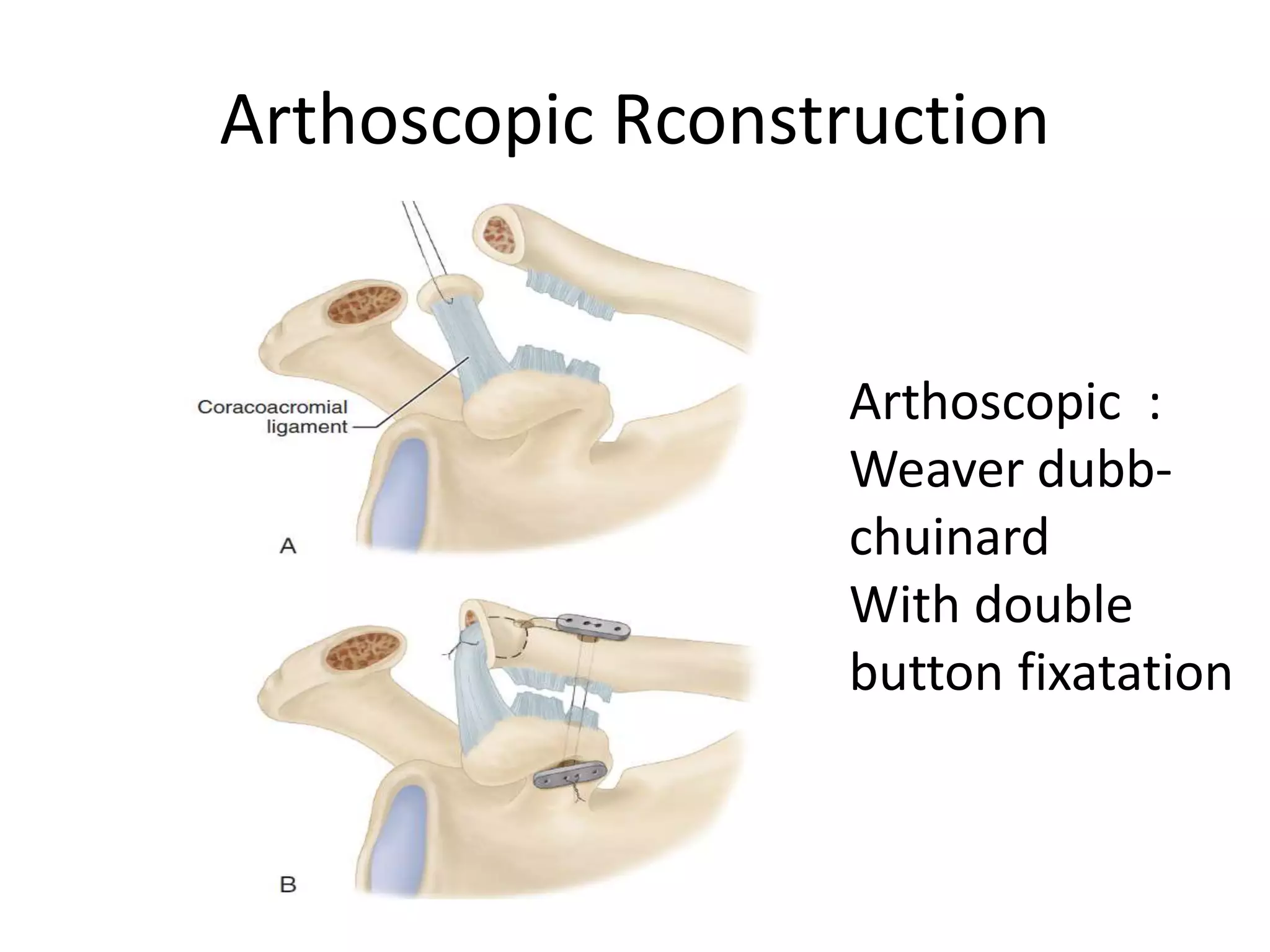 Arthoscopic Rconstruction
Arthoscopic :
Weaver dubb-
chuinard
With double
button fixatation
 
