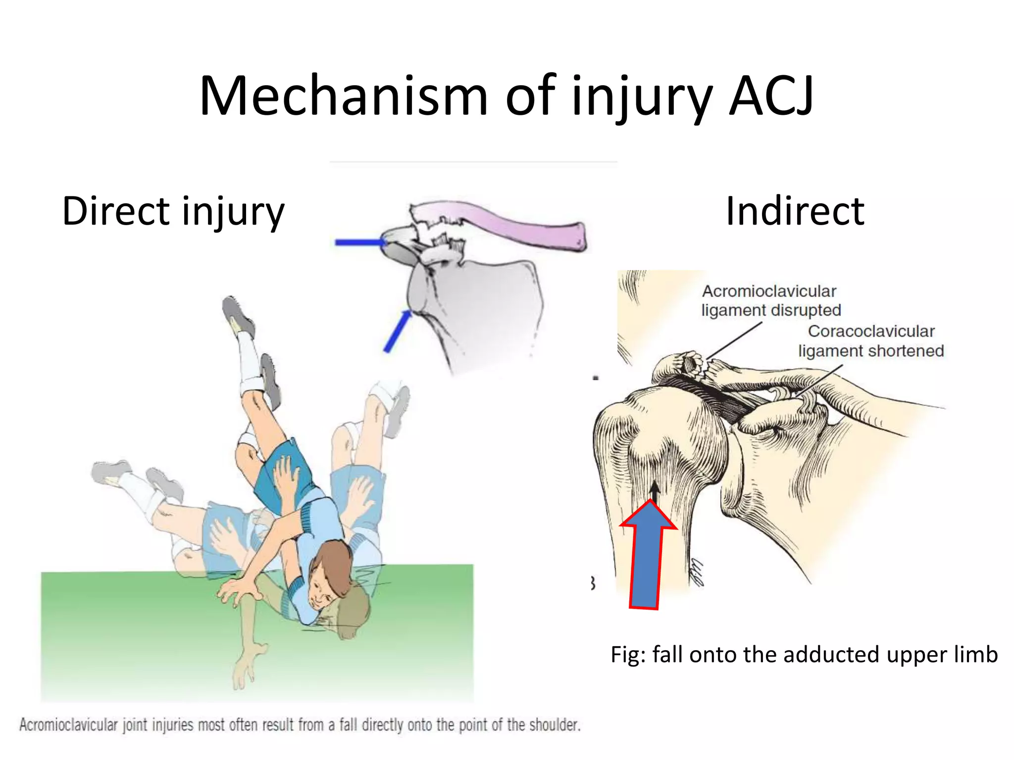 Mechanism of injury ACJ
Direct injury Indirect
Fig: fall onto the adducted upper limb
 