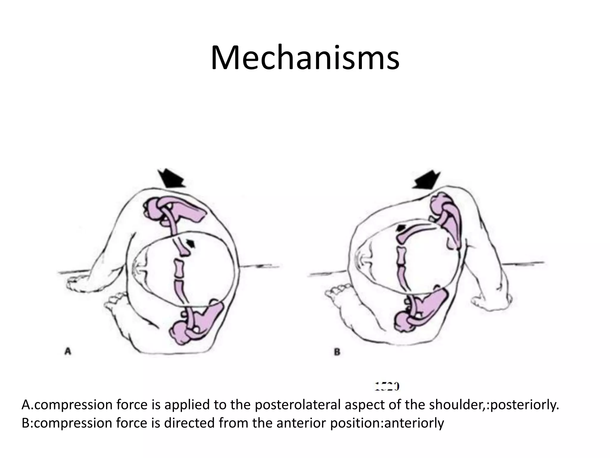 Mechanisms
A.compression force is applied to the posterolateral aspect of the shoulder,:posteriorly.
B:compression force is directed from the anterior position:anteriorly
 