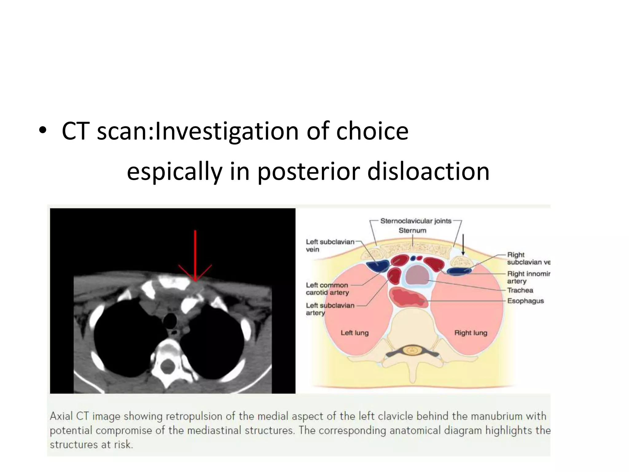 • CT scan:Investigation of choice
espically in posterior disloaction
 