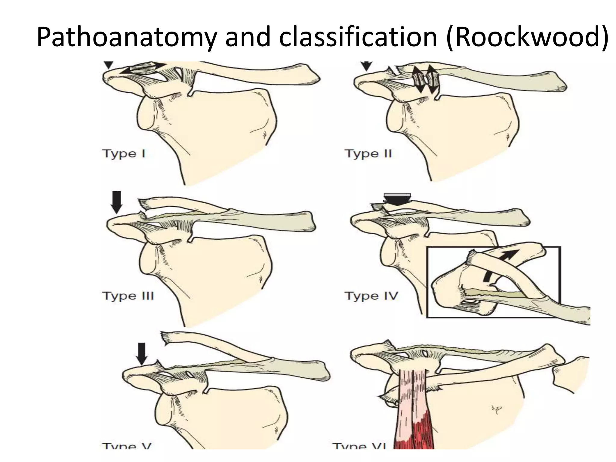 Pathoanatomy and classification (Roockwood)
 