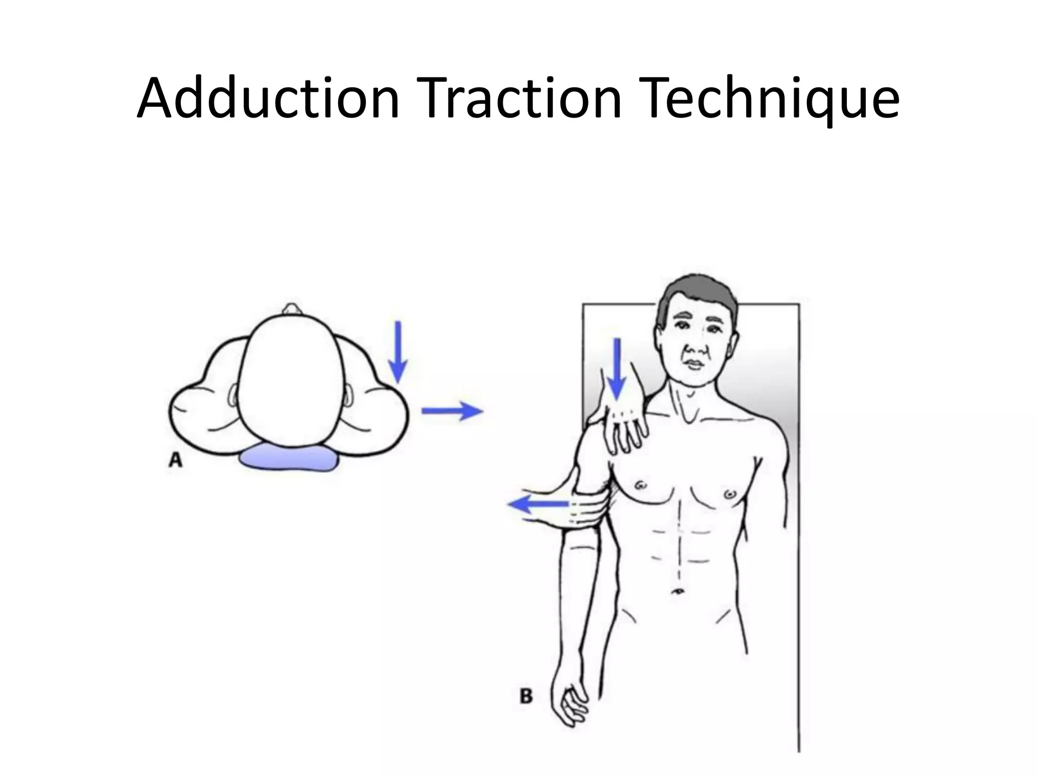 Adduction Traction Technique
 