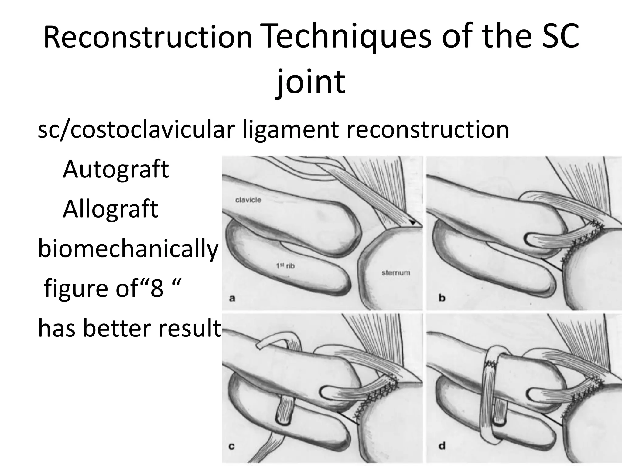 Reconstruction Techniques of the SC
joint
sc/costoclavicular ligament reconstruction
Autograft
Allograft
biomechanically
figure of“8 “
has better result
 