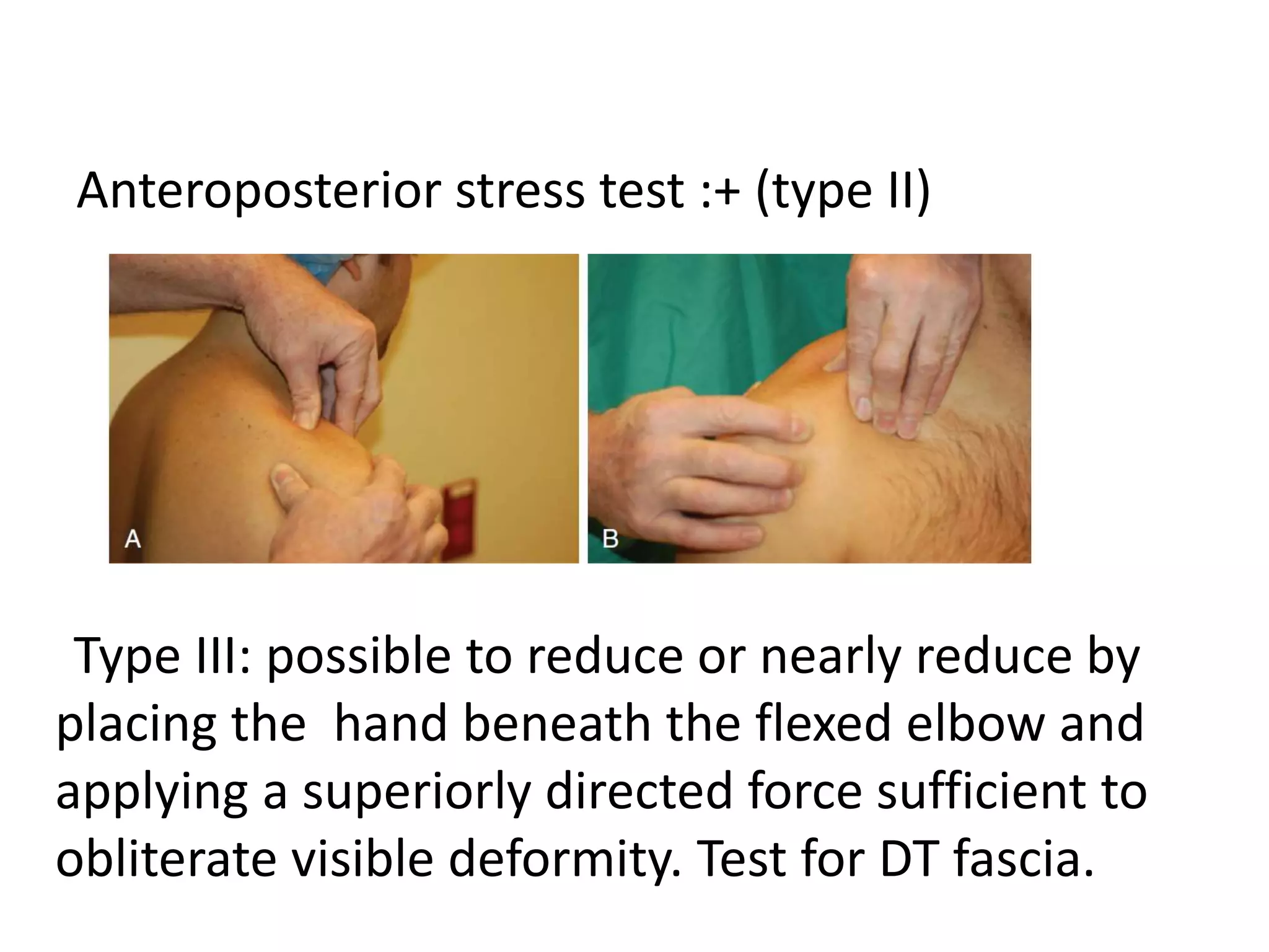 Anteroposterior stress test :+ (type II)
Type III: possible to reduce or nearly reduce by
placing the hand beneath the flexed elbow and
applying a superiorly directed force sufficient to
obliterate visible deformity. Test for DT fascia.
 