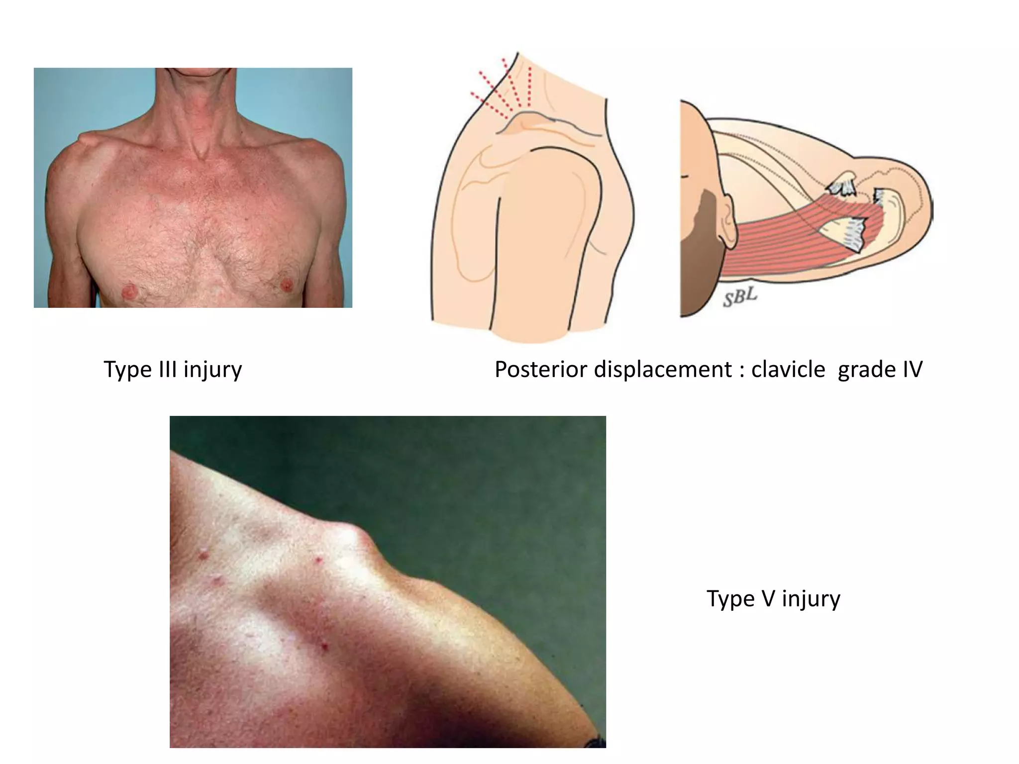 Type III injury Posterior displacement : clavicle grade IV
Type V injury
 