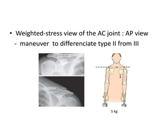 Acromioclavicular and sternoclaviculr injuries | PPTX