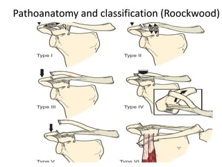 Acromioclavicular and sternoclaviculr injuries | PPTX