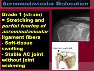 Acromioclavicular Dislocation
Grade 1 (strain)
= Stretching and
partial tearing of
acromioclavicular
ligament fibers
- Soft-tissue
swelling
- Stable AC joint
without joint
widening
 