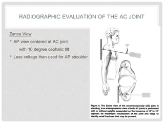 RADIOGRAPHIC EVALUATION OF THE AC JOINT
Zanca View
• AP view centered at AC joint
with 10 degree cephalic tilt
• Less voltage than used for AP shoulder
 