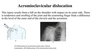 Comprehensive Overview of Acromioclavicular Joint Injuries and Bursitis ...