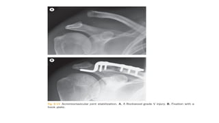 Comprehensive Overview of Acromioclavicular Joint Injuries and Bursitis ...