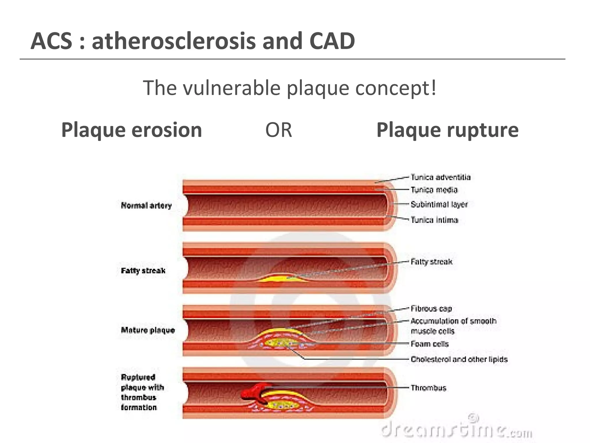 Acute Coronary Syndrome (ACS): Survival of the Species by Dione Nordby ...