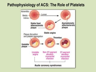 Pathophysiology of ACS: The Role of Platelets
 
